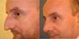 rhinoplastie