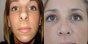 rhinoplasties