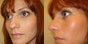 avant apres rhinoplastie