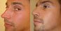 photos rhinoplastie