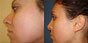 photo chirurgie esthétique du nez