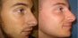 photo patients rhinoplastie